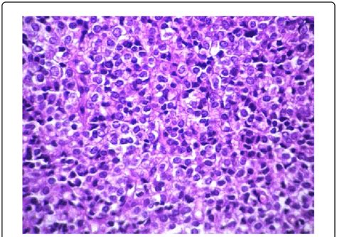 Small Uniform Cells With Scanty Cytoplasm And Round Hyperchromatic