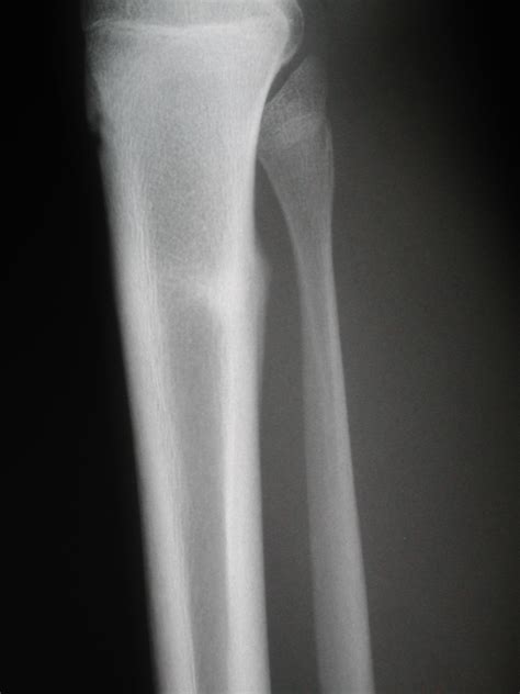 Tibial Shaft Stress Fractures - Knee & Sports - Orthobullets