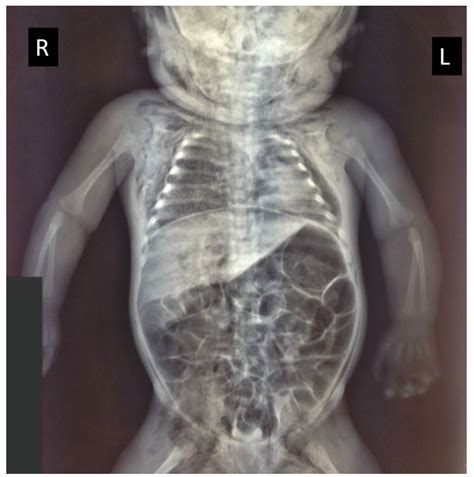 Congenital Cystic Adenomatoid Malformation Ccam Type Ii A Rare Case Of Sudden Infant Death