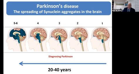 Final Stages Of Parkinsons Disease