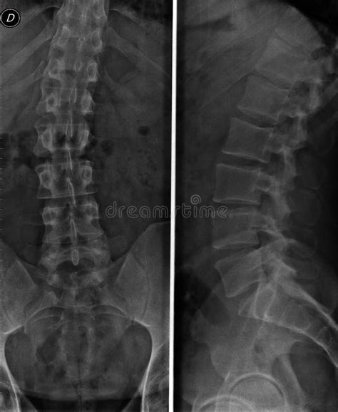 X Ray Of The Lumbar Spine, Spine On X-ray Stock Image - Image of fractures, doctor: 154426507