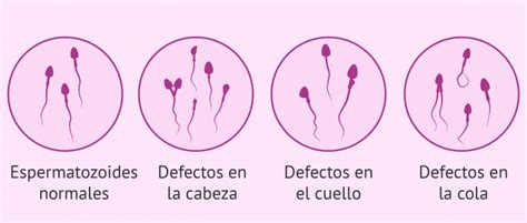 Espermatozoides Anormales