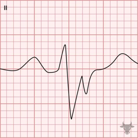 Bifascicular Block | ECG Stampede