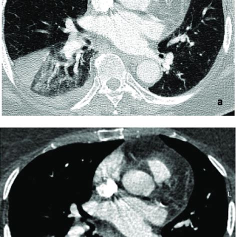 Chest Computed Tomography With Pulmonary Artery Angiography Ctpa A