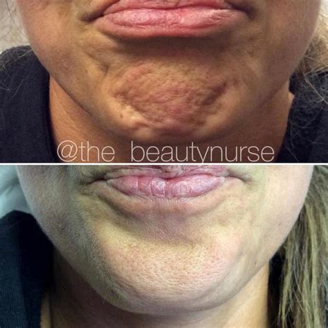 Botox On Chin Dimples Photos » Facial Injections: Info, Prices, Photos ...