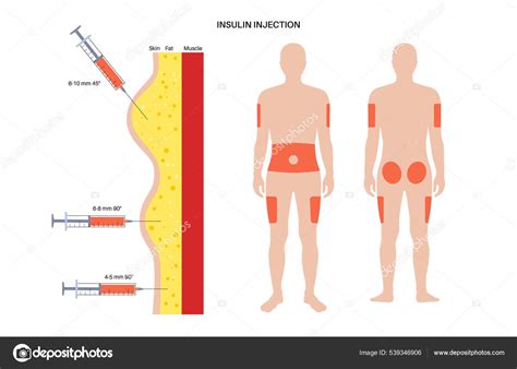 Insulin injection sites Stock Vector by ©Pikovit 539346906