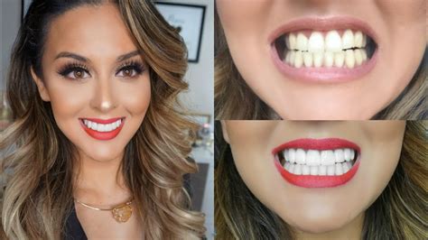 My Teeth Transformation l Veneers Experience - YouTube