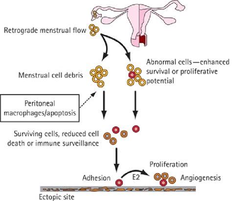 A Theoretical Model Of The Development Of Endometriosis Download