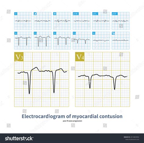 1 Myocardial Contusion Images, Stock Photos & Vectors | Shutterstock