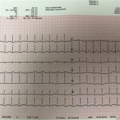 Electrocardiography Revealed Only Sinus Tachycardia With Otherwise