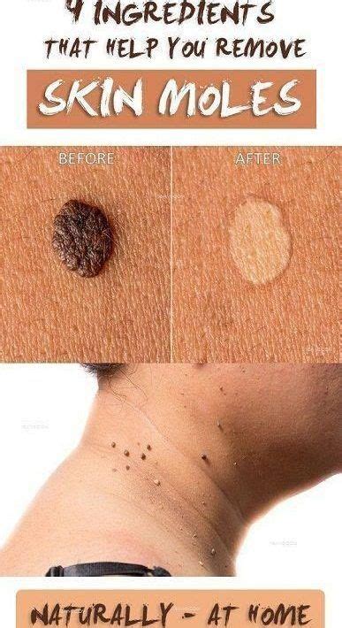 How To Get Rid Of Moles Naturally And Fast In 2020 Home Remedies