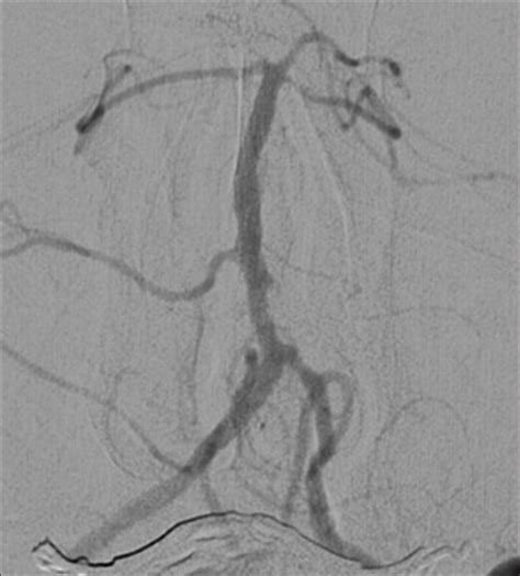 Example Patient 1s Follow Up Angiography Follow Up Angiography Nearly