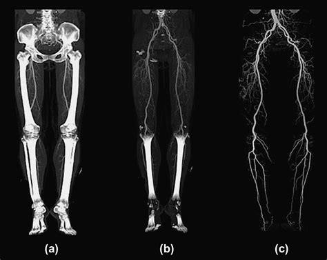 Dual Energy Ct Angiography Of Pelvic And Lower Extremity Arteries Dual Energy Bone Subtraction