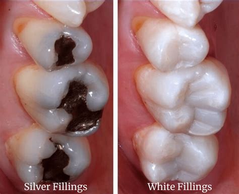 White Fillings London Hermes Cosmetic Dentistry London