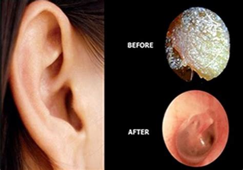 Microsuction Rochdale Ear Care Clinic