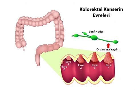 ColoAlert Test Kolorektal Kanser Taraması Biruni Genetik