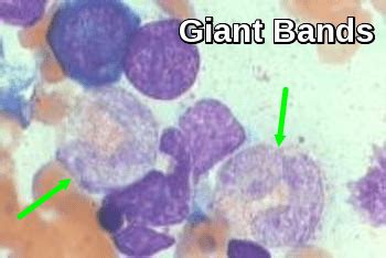 Blood Morphology Ask Hematologist Understand Hematology