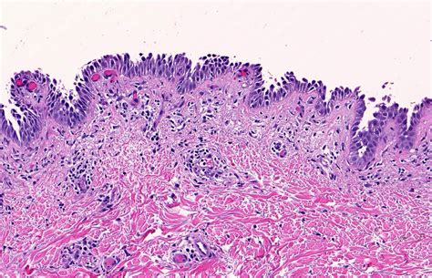 Pemphigus Foliaceus Histology