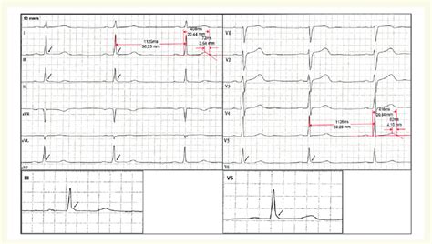 Twelve Lead Electrocardiogram Showing A Notching Type Erp In Inferior