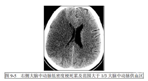 规范学习系列：中国脑血管病影像学指导规范③急性缺血性脑卒中影像学指导规范（2021） 脑医汇 神外资讯 神介资讯