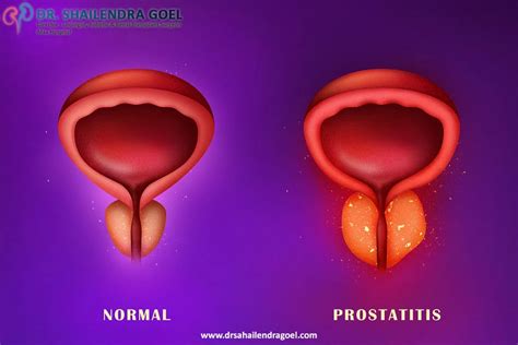 What Is Prostatitis Causes Symptoms And Treatment