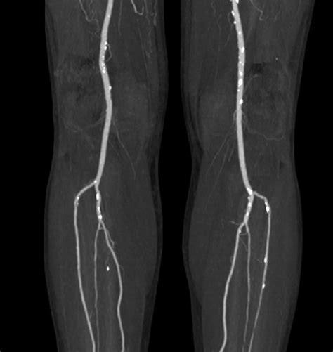 Ct Angiography Of Suspected Peripheral Artery Disease Comparison Of Contrast Enhancement In The