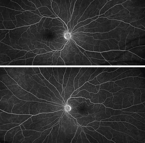 Cystoid Macular Edema Fluorescein Angiography