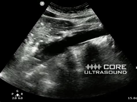 Abdominal Aorta Ultrasound