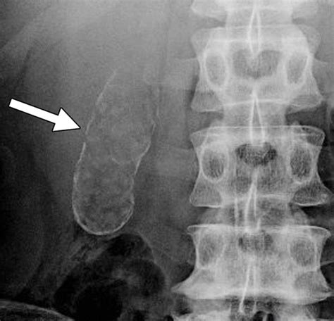 Diagnostic Approach To Benign And Malignant Calcifications In The Abdomen And Pelvis Radiographics