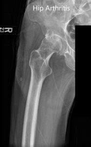 Case Study Bilateral Total Hip Arthritis In Yr Old Male