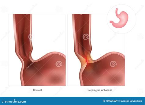 Esophageal Achalasia Disease With Lower Sphincter Failure Outline