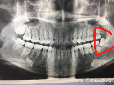 位置重庆，求拔智齿经验，哪家医院技术强 知乎