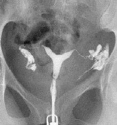 Histerosalpingografía CLÍNICA DE RADIOLOGIA JULIO RAMBLA