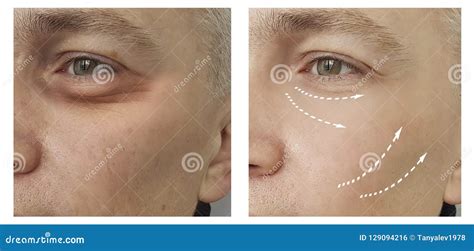 Man Wrinkles before and after Surgery Removal Aging Procedures ...