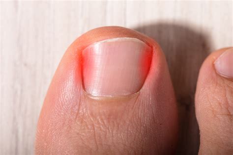 Ingrown Toenail Remedies You Can Do At Home Podogo