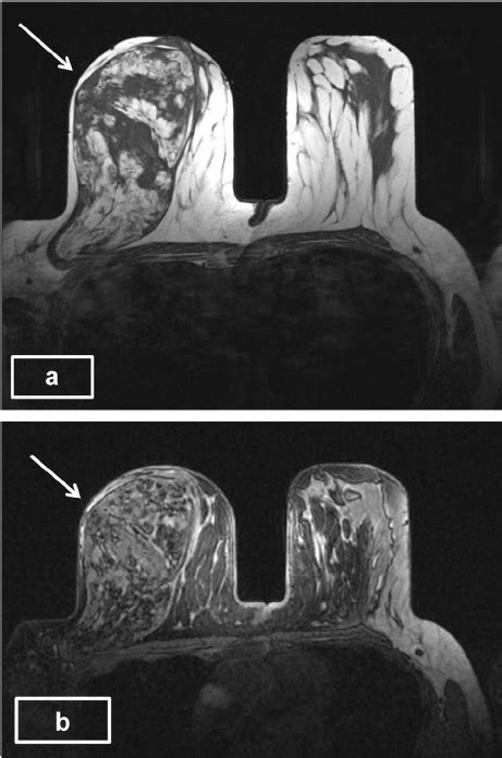 A And B T1 Weighted And Post Contrast T1 Download Scientific Diagram