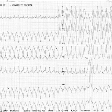 Presenting Electrocardiogram Showing Ventricular Tachycardia Download