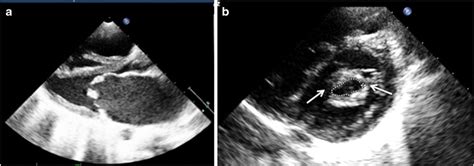 Rheumatic Mitral Valve Disease Acep American College Of Emergency