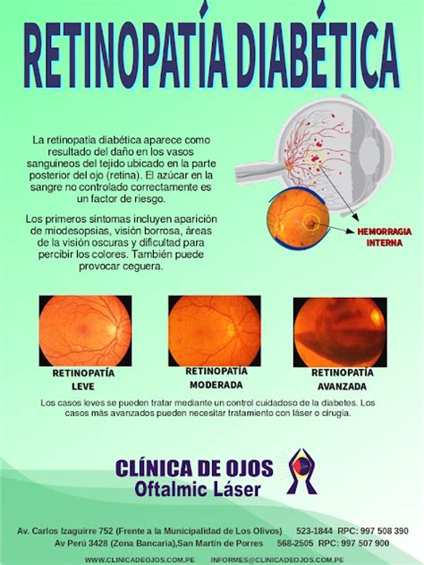 Cl Nica De Ojos Oftalmic L Ser Retinopat A Diab Tica