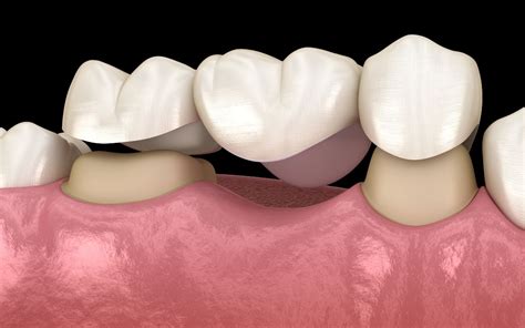 What Are The Pros And Cons Of Dental Bridges Molesey