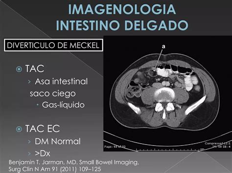 Imagenologia De Intestino Delgado Ppt