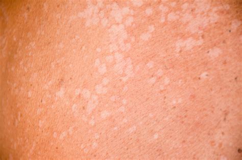 Tinea Versicolor Katu Dermatology Clinic