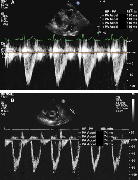 Normal Reference Values And Z Scores Of The Pulmonary Artery