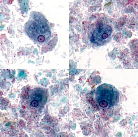 Pathology Outlines Entamoeba