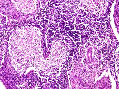 Acute Appendicitis Histology