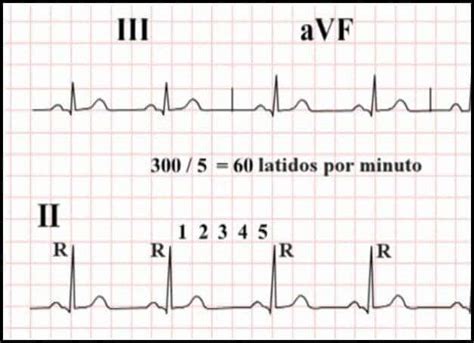 How To Determine Heart Rate On Ecg Cerebro Medico