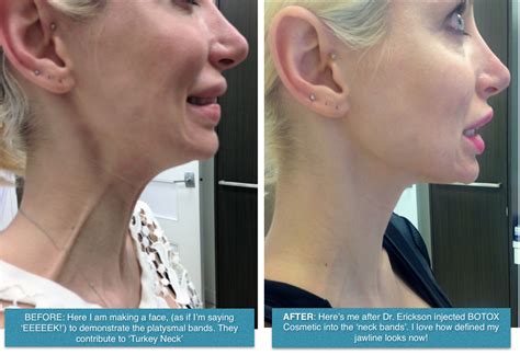 E Experiments Botox In The Bands Aka The Nefertiti Lift — Med E Spa