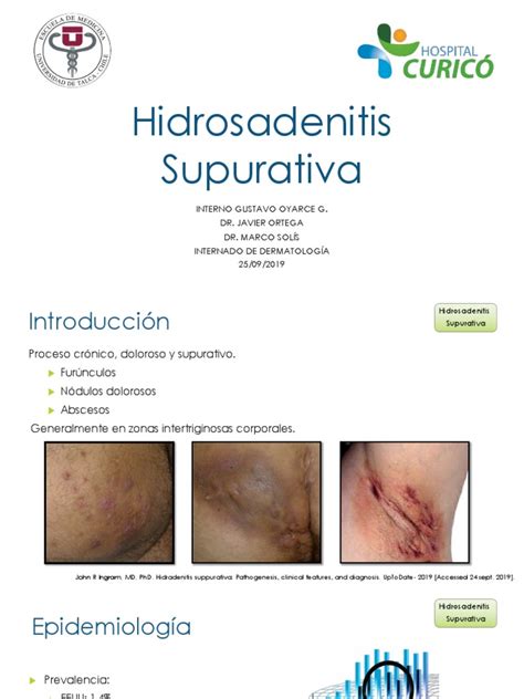 Hidrosadenitis Supurativa Pdf Enfermedades Y Trastornos Medicina Clinica