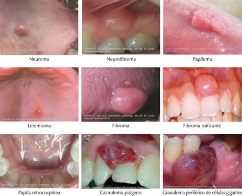 Giant Cell Fibroma Presentation Of 122 Cases