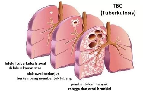 Tuberkulosis Tbc Gejala Penyebab Dan Cara Mengobatinya